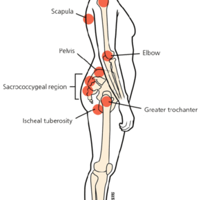 Hypothetical Research on Pressure Ulcer (PU) in a Hospital Setting.