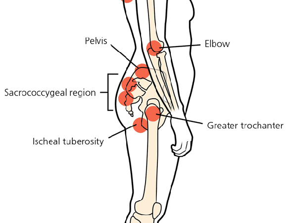 Hypothetical Research on Pressure Ulcer (PU) in a Hospital Setting.