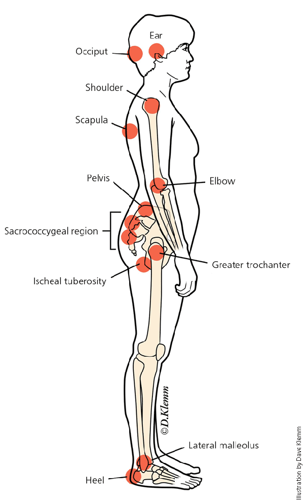 Hypothetical Research on Pressure Ulcer (PU) in a Hospital Setting.